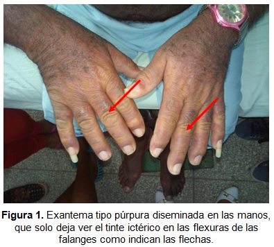 Sindrome de DRESS (Dermatología)