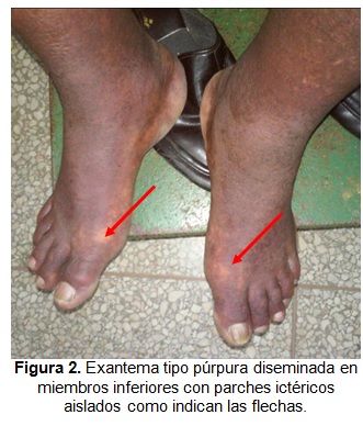 DRESS: Sindrome de hipersensibilidad a la Dapsona – PIEL-L Latinoamericana